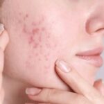Acne Scar Treatment