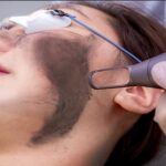 Carbon Peel