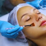 Chemical Peel