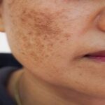 Face Pigmentation