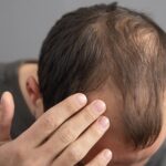 Hair Fall Treatment