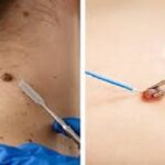 Laser Mole Removal