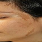 Melasma
