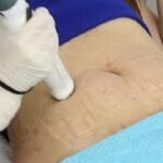 Stretch Marks Treatment