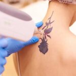 Tattoo Removal Treatment
