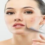 anti acne jfir