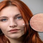 strawberry-skin